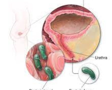 Urinary Tract Infection ( UTI )